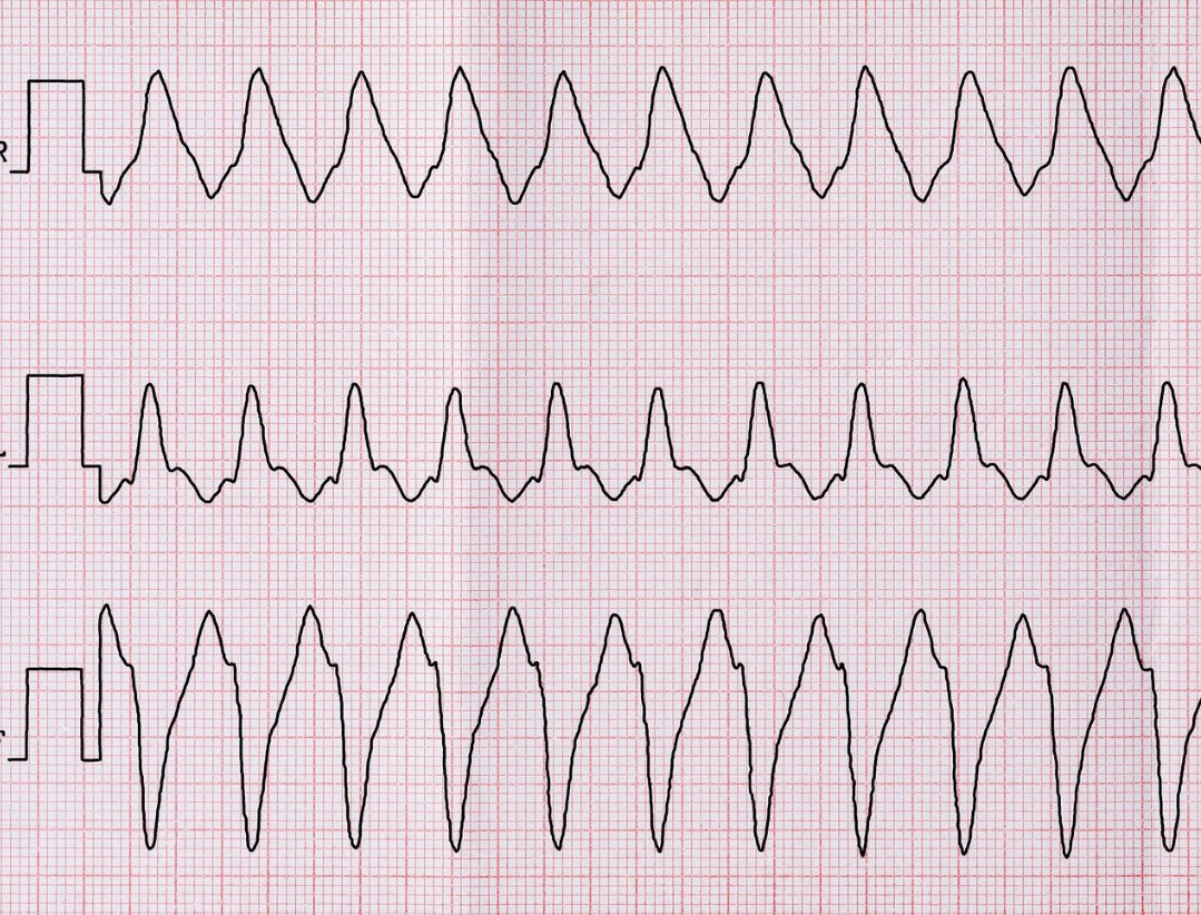 zeigt ein EKG mit ventrikulärer Tachykardie als Hinweis wann eine Kardioversion durchgeführt werden kann.